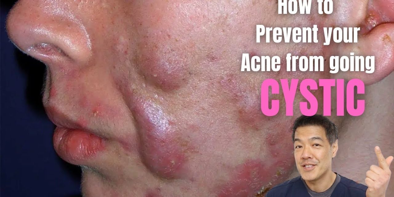 Cara Mengobati Cystic Acne Secara Bertahap Dan Juga Rutin