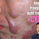 Cara Mengobati Cystic Acne Secara Bertahap Dan Juga Rutin