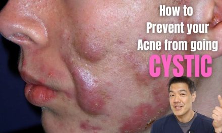 Cara Mengobati Cystic Acne Secara Bertahap Dan Juga Rutin